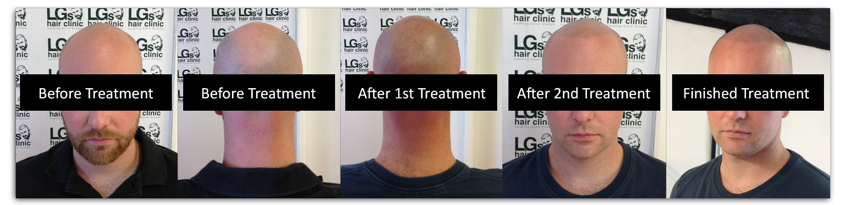 ... Hair Falling And Recover New Hair | Complete Hair Baldness-LGs Hair
